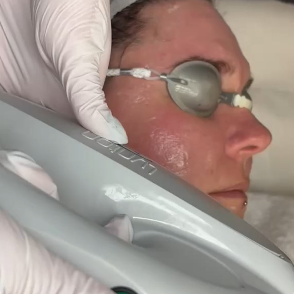 The Skin Reset Programme | IPL Illumi Facial